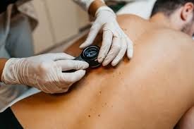 Skin Cancer Checks